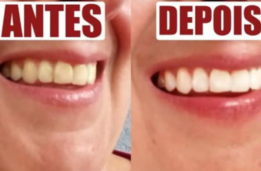 clarear os dentes